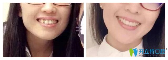 青島維樂口腔<!--<i data=20240703-sp></i>-->牙齒矯正怎么樣？案例效果來驗證