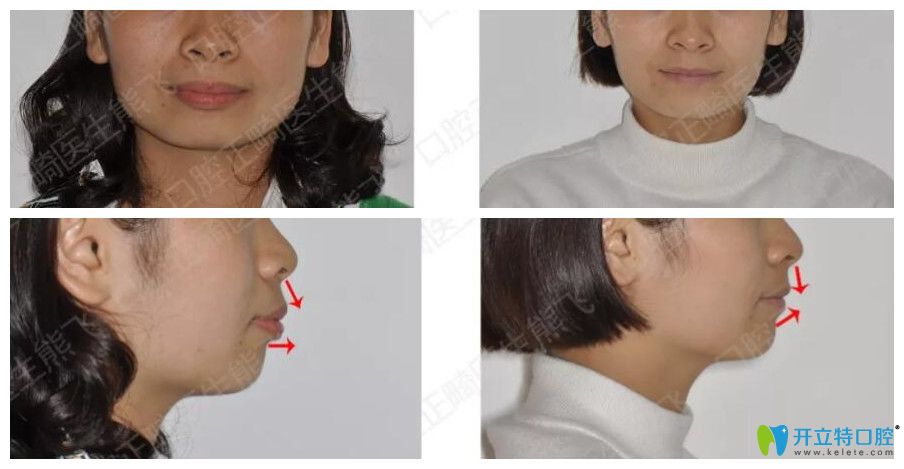 圣貝口腔正畸怎么樣？來看熊飛突嘴齙牙矯正案例前后效果對比
