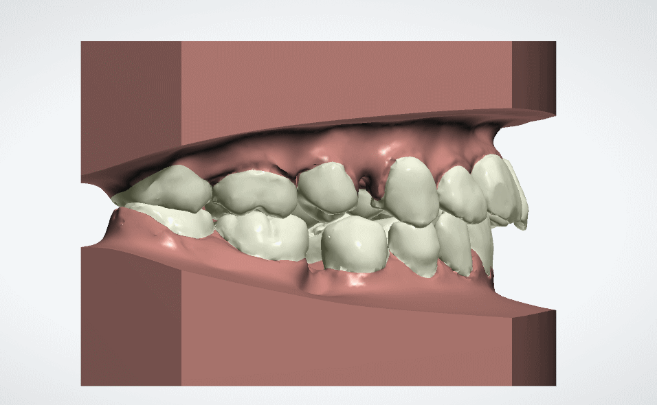 牙齒矯正移動(dòng)圖