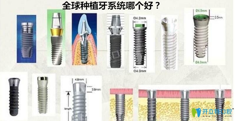 種植牙系統(tǒng)哪個好？來看世界種植體排名詳情及價格表