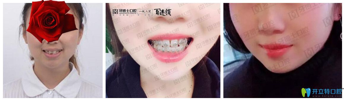 重慶成佳牙博士怎么樣，坑人嗎？看牙博士口腔醫(yī)生矯正真人案例