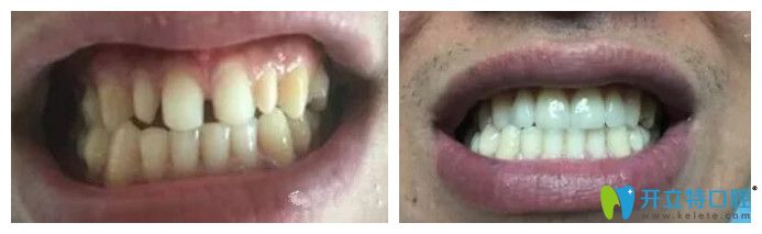 北京中諾口腔劉曉清怎么樣？來看瓷貼面修復(fù)牙齒案例效果
