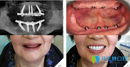 沈陽(yáng)歡樂(lè)仁愛(ài)口腔全口牙種植對(duì)比圖