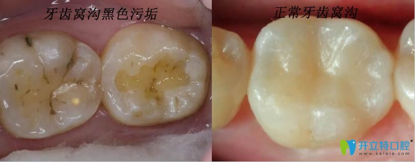 牙齒上的黑色污垢是蛀牙嗎？那蛀牙如何讓它停止腐蝕呢？