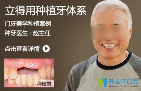 北京中諾趙振宇種植牙怎么樣？案例及顧客反饋來看