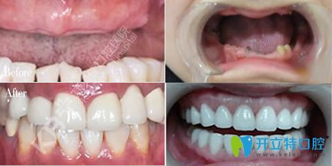沈陽(yáng)康貝佳口腔半口和全口牙種植圖
