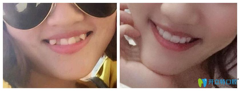 有虎牙能做矯正嗎？看重慶牙博士口腔虎牙隱形矯正案例效果對比圖