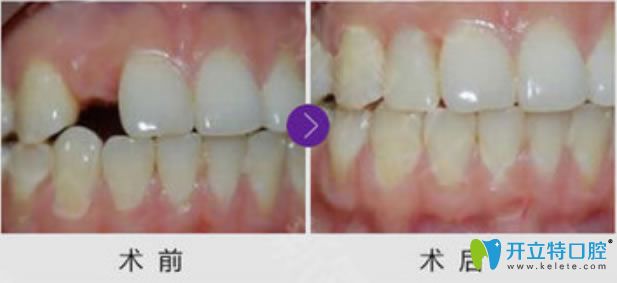 洛陽拜博口腔單顆牙缺失種植牙前后對比效果 洛陽拜博口腔單顆牙缺失種植牙前后對比效果