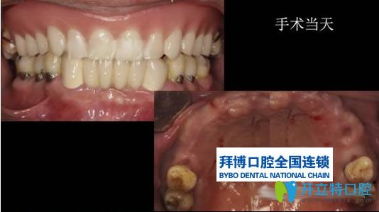 楊小林醫(yī)生無牙頜種植病例前后對比效果 楊小林醫(yī)生無牙頜種植病例前后對比效果