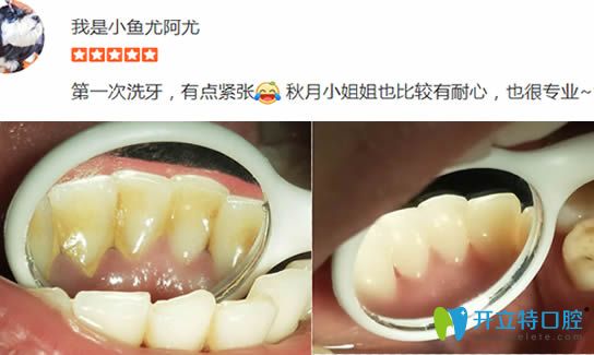 顧客在洛陽拜博洗牙前后對比效果圖 顧客在洛陽拜博洗牙前后對比效果圖