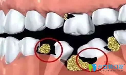 牙齒缺失時(shí)間長不補(bǔ)會(huì)怎么樣