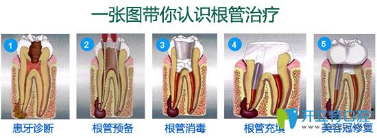 廊坊愛嘉口腔李恩基醫(yī)生介紹根管治療