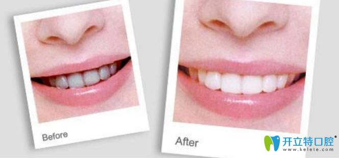 牙齒噴砂和拋光區(qū)別是什么，哪個好