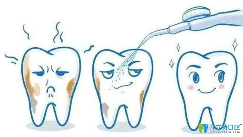 洗牙時噴砂就是拋光嗎