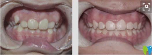 周驊醫(yī)生成人時代天使隱形矯正前后對比效果 周驊醫(yī)生成人時代天使隱形矯正前后對比效果