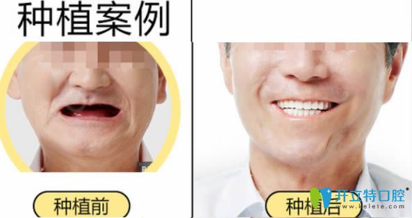 <!--<i data=20240703-sp></i>-->宏康李敬主任全口種植牙前后對比效果圖 <!--<i data=20240703-sp></i>-->宏康李敬主任全口種植牙前后對比效果圖