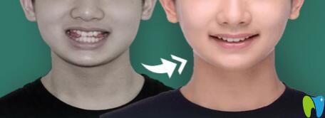 重慶華美口腔丁愛軍怎么樣？真人案例來驗證