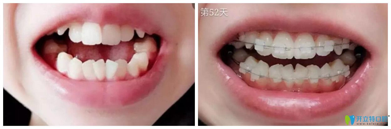 漢中小白象口腔戴半隱形牙套矯正52天