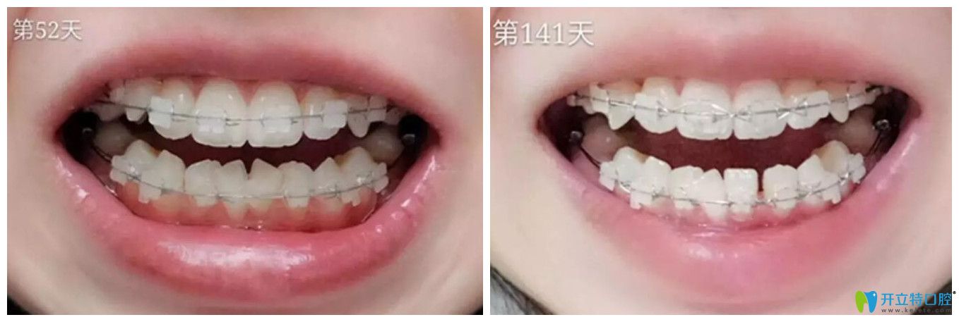 小白象口腔半隱形矯正52天和141天對比圖