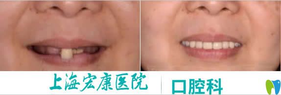 <!--<i data=20240703-sp></i>-->宏康口腔科67歲老人全口種植牙前后對比效果 <!--<i data=20240703-sp></i>-->宏康口腔科67歲老人全口種植牙前后對比效果