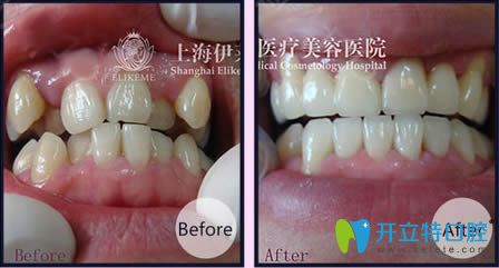 <!--<i data=20240703-sp></i>-->伊萊美王海鑫醫(yī)生虎牙矯正前后對比照 <!--<i data=20240703-sp></i>-->伊萊美王海鑫醫(yī)生虎牙矯正前后對比照