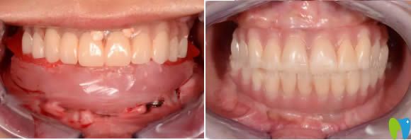 做完全口種植牙后的即可效果 做完全口種植牙后的即可效果