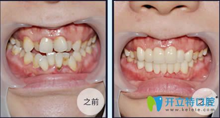 <!--<i data=20240703-sp></i>-->伊萊美牙科李慶云牙齒擁擠矯正前后對比效果 <!--<i data=20240703-sp></i>-->伊萊美牙科李慶云牙齒擁擠矯正前后對比效果