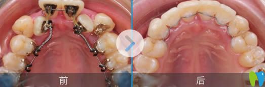 伊萊美口腔李真旼博士舌側(cè)矯正前后對比效果圖 伊萊美口腔李真旼博士舌側(cè)矯正前后對比效果圖