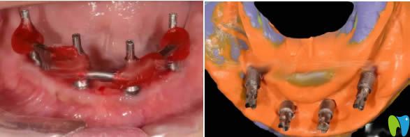 植入種植系統(tǒng)后的照片 植入種植系統(tǒng)后的照片