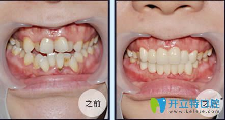 王海鑫醫(yī)生3M牙齒托槽矯正14個(gè)月對(duì)比效果