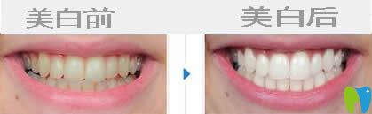 北京京通口腔徐澤鵬牙齒美白案例
