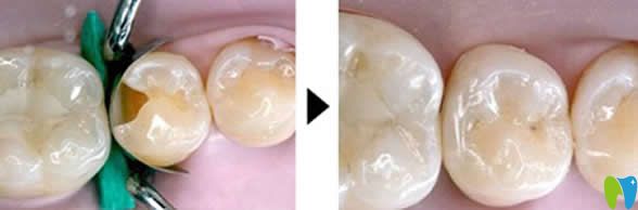 網(wǎng)上說千萬不要去補牙是真的嗎