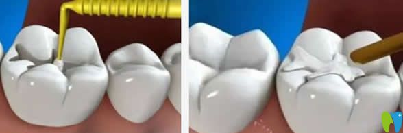 補牙會越補越爛嗎