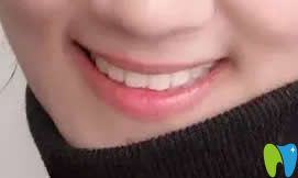 我在北京京通口腔做牙齒矯正14個月