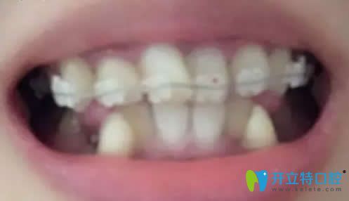 我在北京京通口腔做陶瓷托槽牙齒矯正第1個月