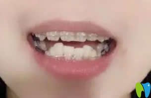 我在北京京通口腔做牙齒矯正第6個月