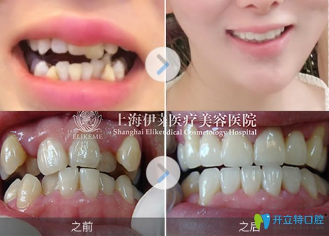虎牙選擇隱適美隱形矯正前后對比照