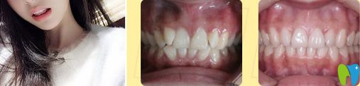 牙齒矯效果圖