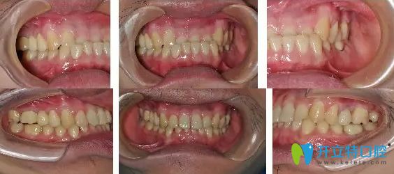 北京京通口腔李夢華醫(yī)生反頜矯正案例