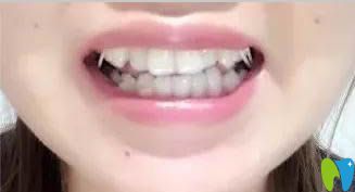 我在臺州維多利亞口腔做戴隱形牙套17副時效果圖