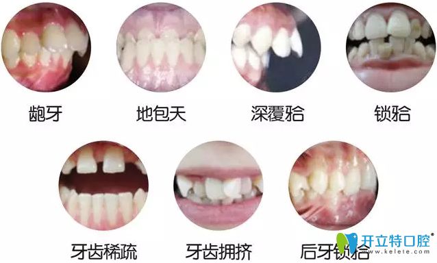 活動(dòng)翼牙齒矯正的優(yōu)缺點(diǎn)