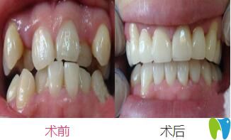 戴時代天使隱形矯正器矯正擁擠不齊牙齒案例前后效果對比
