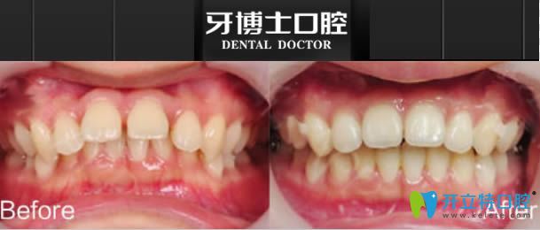 寧波牙博士口腔深覆蓋牙齒矯正前后對(duì)比照