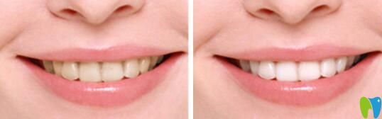 梅州哪家做牙齒美白效果好？愛麗諾牙齒冷光美白效果公布