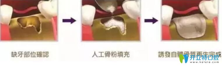 骨粉是個什么東西？為什么種牙要植骨粉
