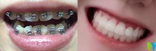 金屬托槽牙齒矯正案例效果