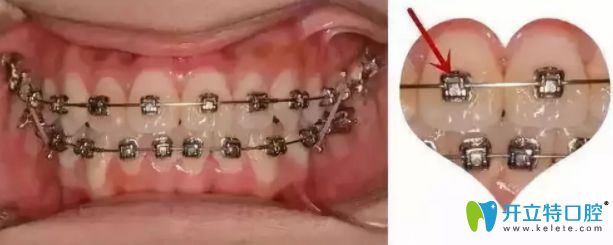 干貨：牙齒矯正托槽掉了怎么辦？托槽掉了必須馬上粘嗎?