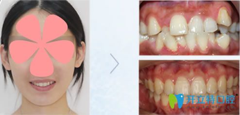 楚丹丹醫(yī)師采用直絲弓矯正技術的正畸對比效果