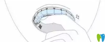 隱適美牙套戴入方法