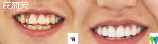 金華芘麗芙口腔矯正虎牙前后對比效果 金華芘麗芙口腔矯正虎牙前后對比效果